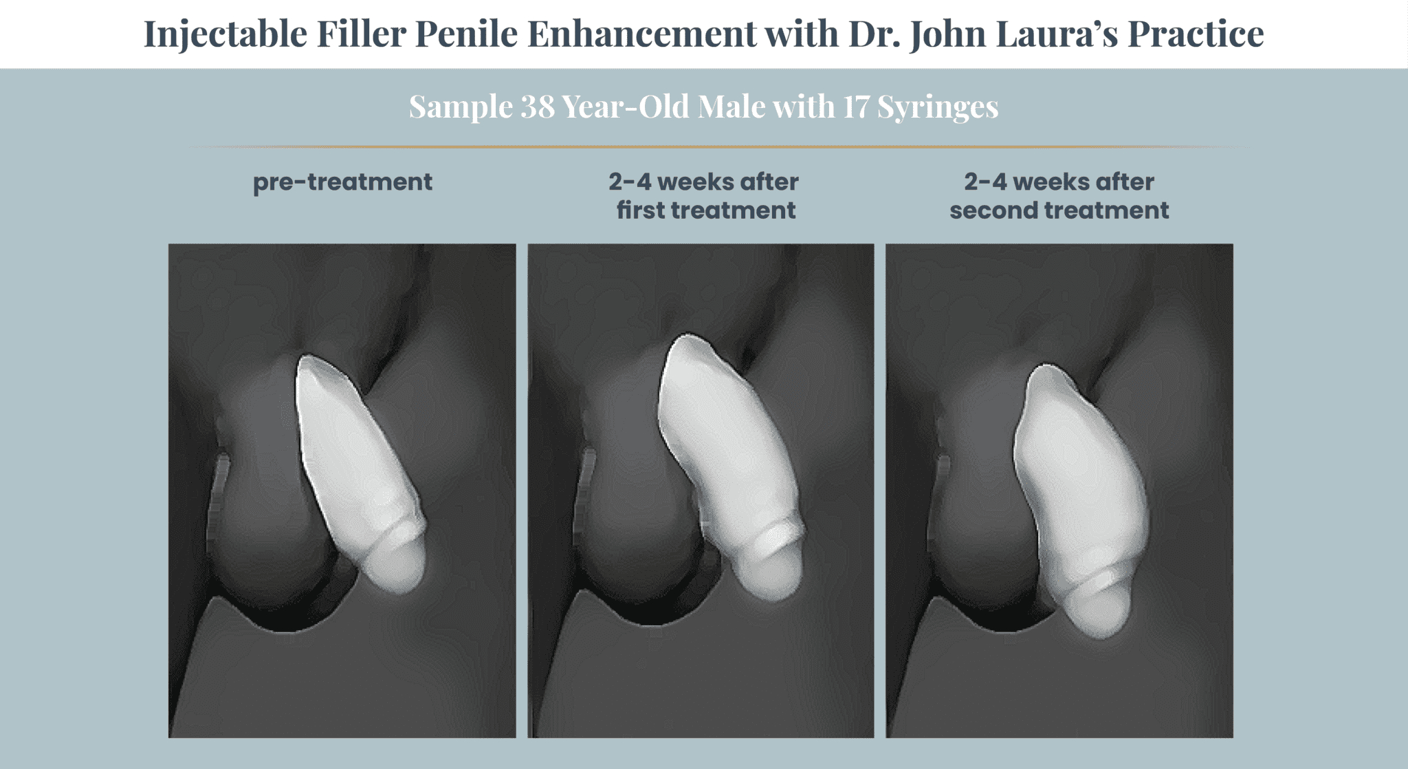 Penis Enlargement Surgery: Length & Girth Enhancement