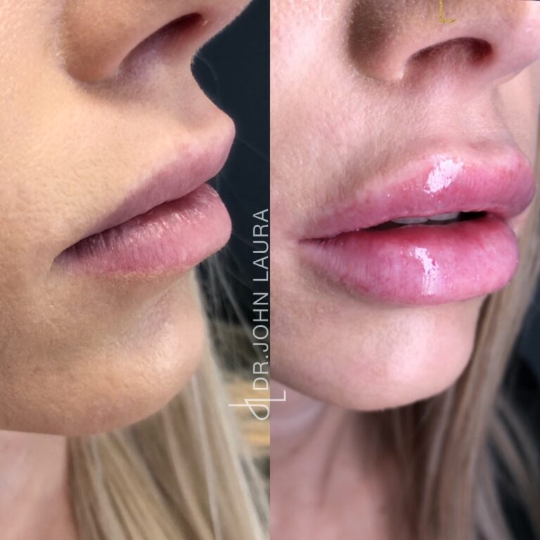 Lip filler before after 2