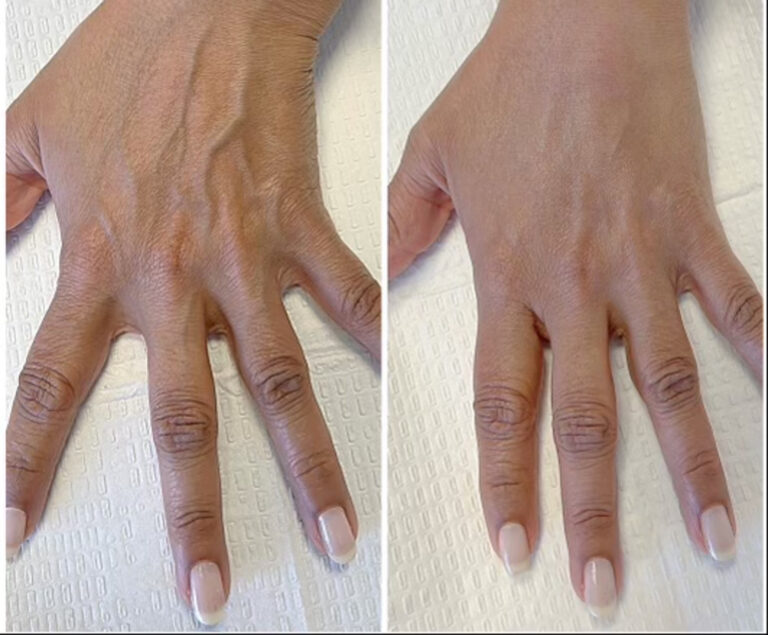 hand filler before after 1