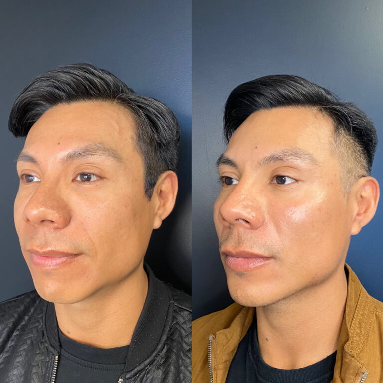Jawline filler before after 4