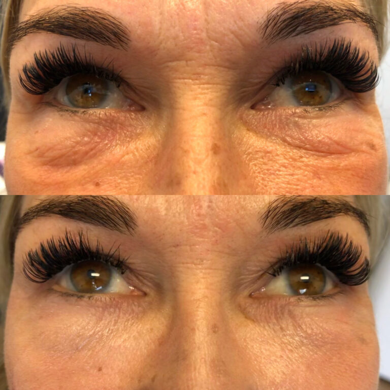 under eye filler