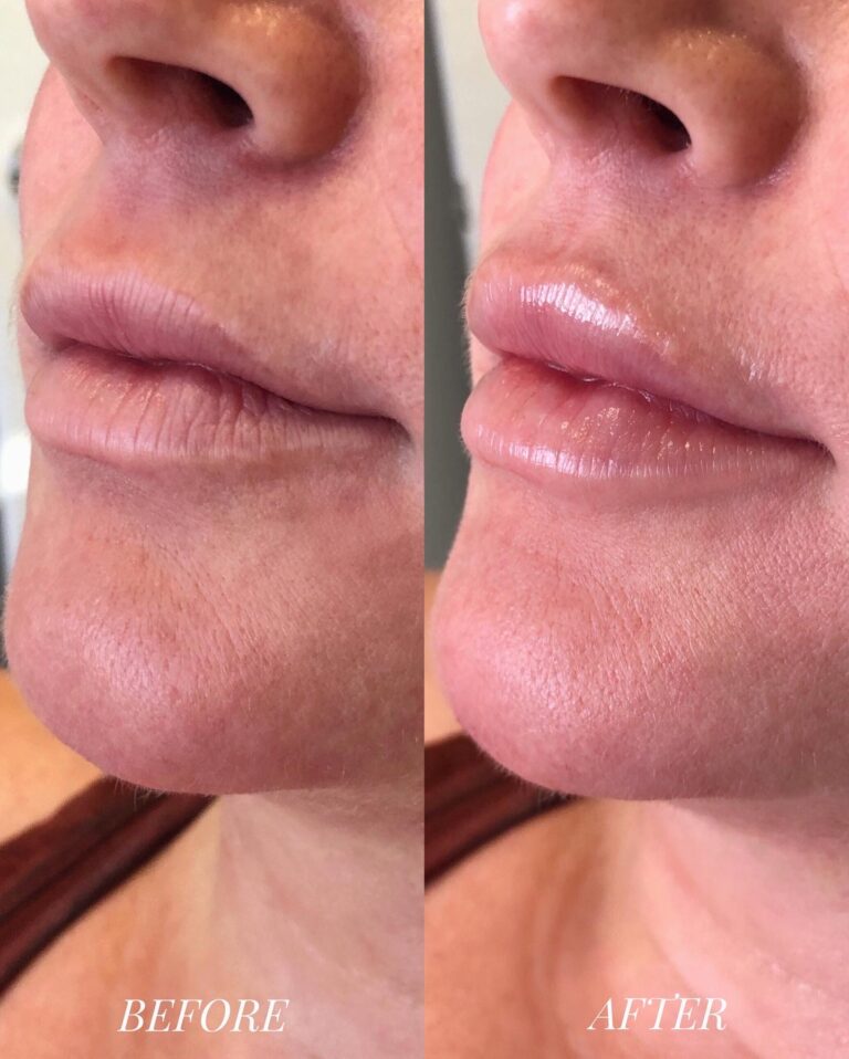 Lip filler before after 4