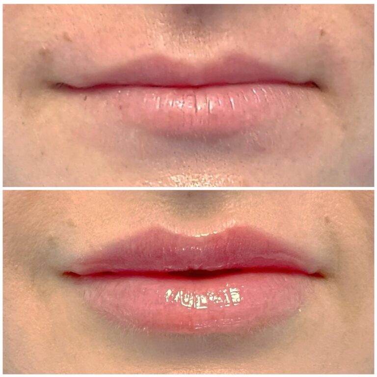 Lip filler before after 5
