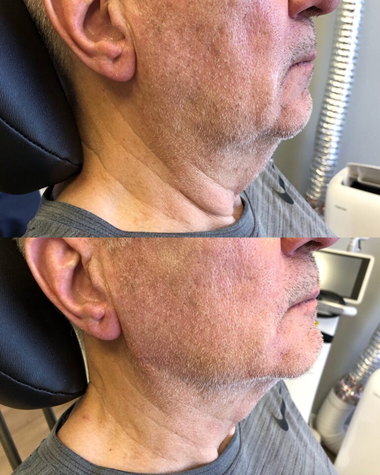 Jawline filler before after 1