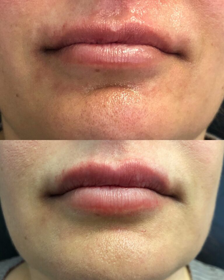 Lip filler before after 6