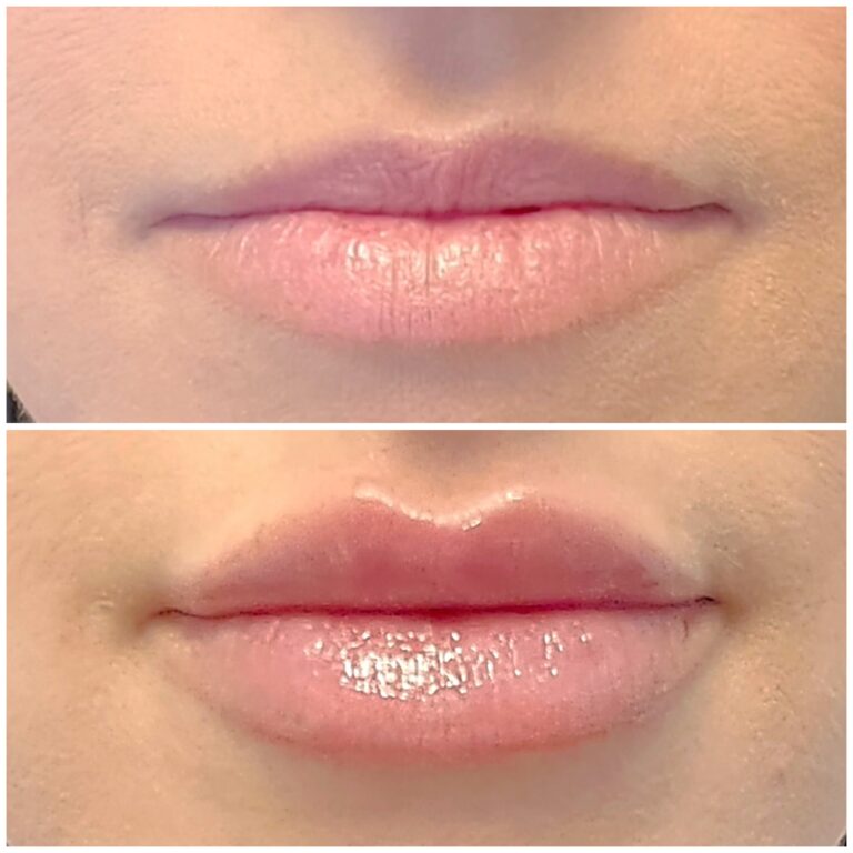Lip filler before after 8