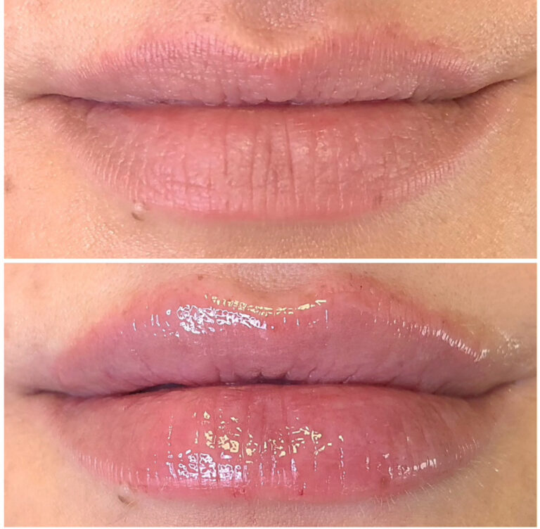 lip filler before after 11