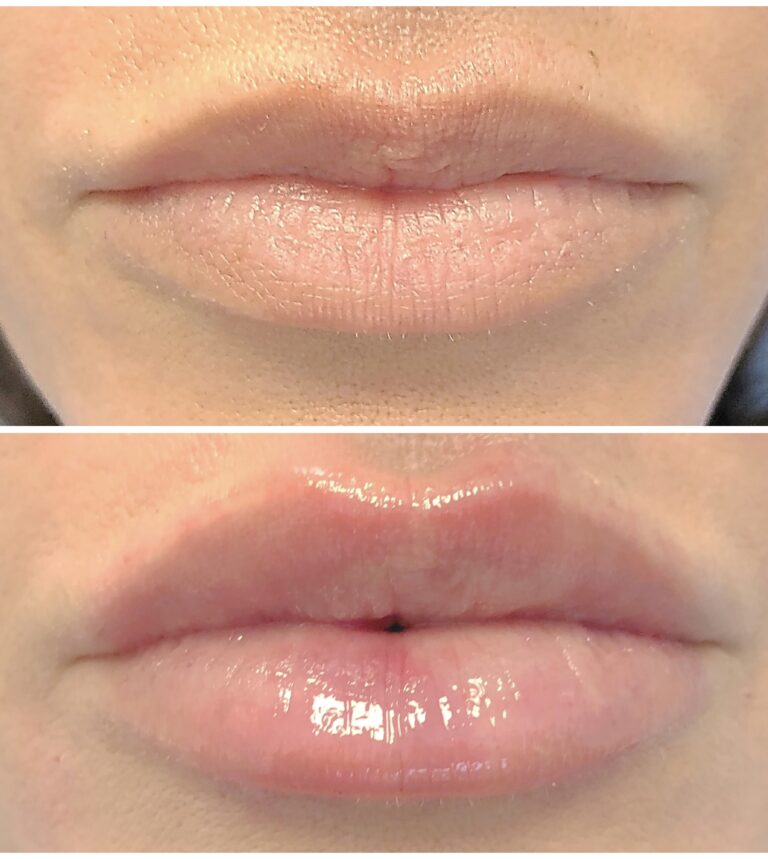 lip filler before after 10
