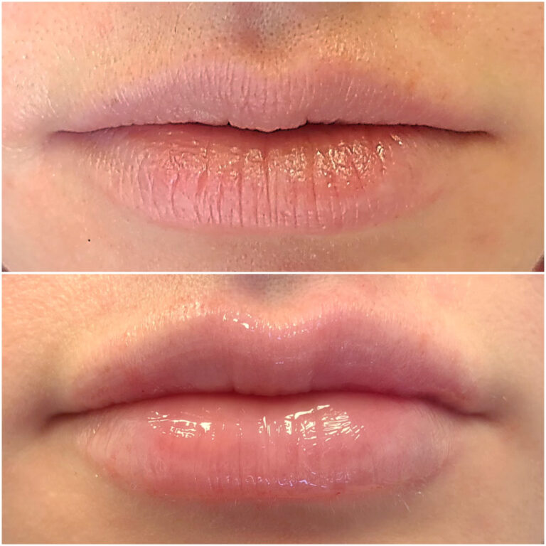 Lip filler before after 12