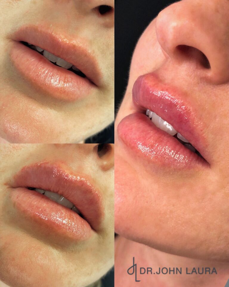 Lip filler before after 9