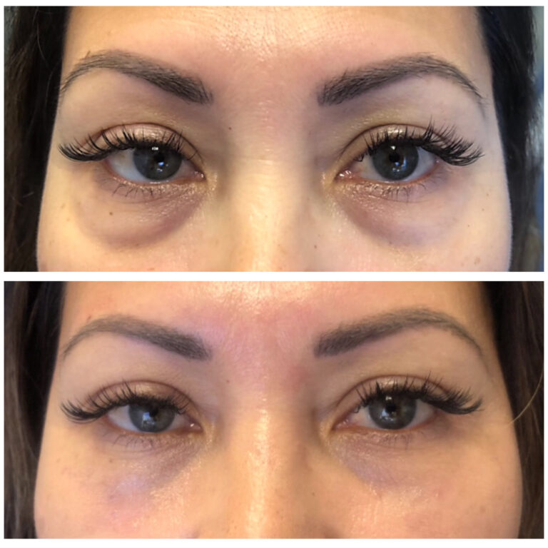 filler undereye before after 2