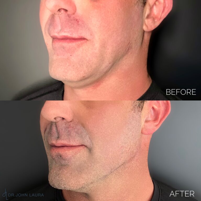 jawline filler before after 3