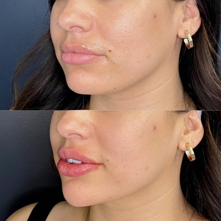 jowls filler before after 1