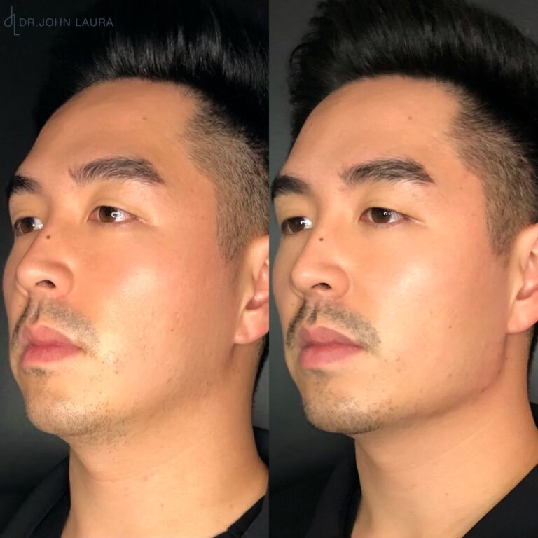 Jawline filler before after 2